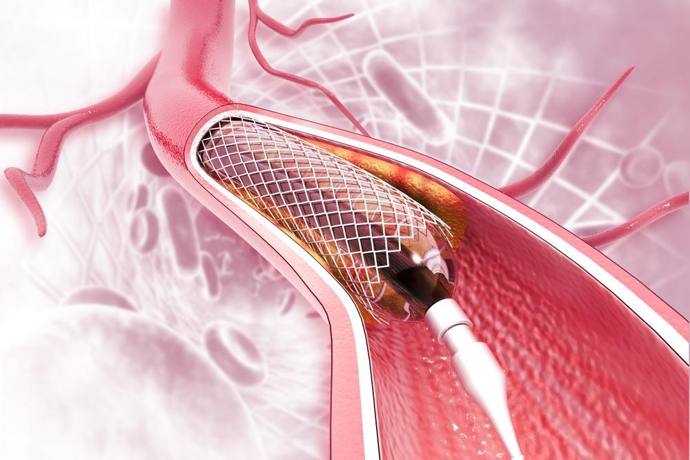 Interventional cardiologist in phoenix az tri city cardiology