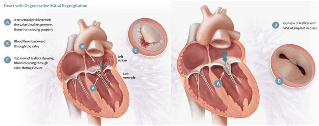 heart mitral valve regurgitation