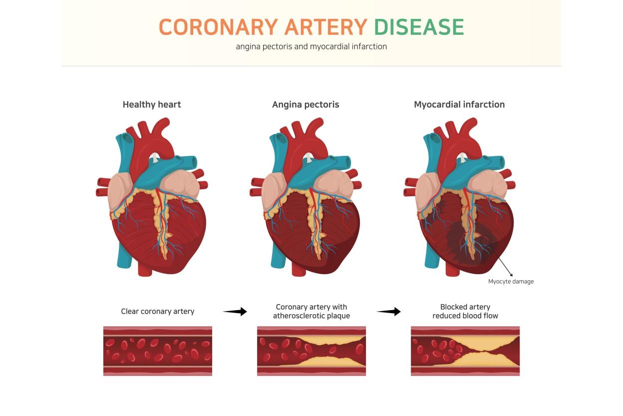Coronary Artery Disease Specialist in Phoenix, AZ Tri City Cardiology